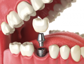 Trồng Răng Implant – Giải Pháp Hoàn Hảo Thay Thế Răng Mất