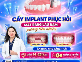 Cấy implant phục hồi mất răng lâu năm, xương tiêu nhiều