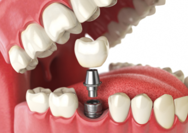 Trồng Răng Implant – Giải Pháp Hoàn Hảo Thay Thế Răng Mất