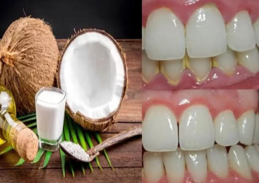 Hướng dẫn lấy cao răng tại nhà an toàn, hiệu quả